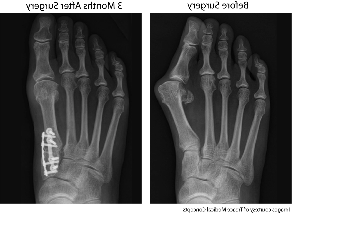 Bunion before surgery versus three months after Lapiplasty surgery